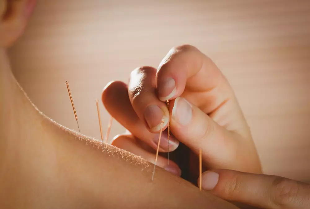 Acupuncture in Encino & Los Angeles